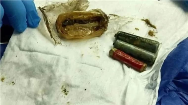 مصر.. إخراج 3 بطاريات من معدة مريض