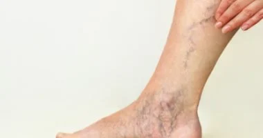 أسباب تمدد الأوعية الدموية والأعراض والعلاج