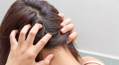 حكة فروة الرأس تضعف الشعر.. نصائح ضرورية لتجنبها