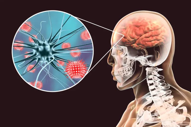 التهاب الدماغ بعد العدوى يُسبب ضعف العضلات