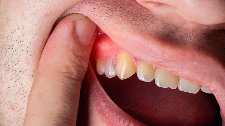 خراج الضرس و علاجه في المنزل