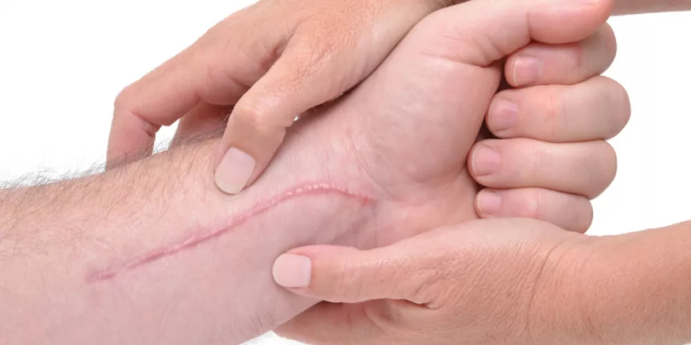 دودة تعمل على علاج ندوب البشر
