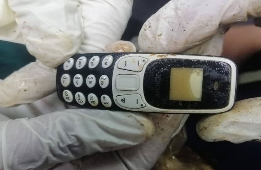 استخراج هاتف محمول من بطن شاب مصري بعد عامين من ابتلاعه