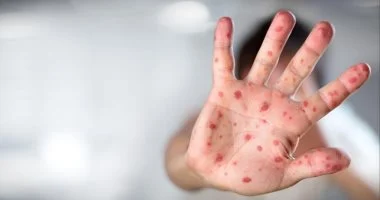 كل ما تريدون معرفته عن جدري القرود