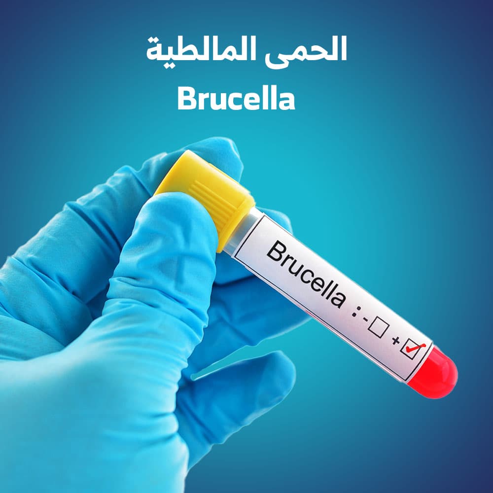 تعرف على الحمى المالطية وكيف تنتقل الى الانسان ؟