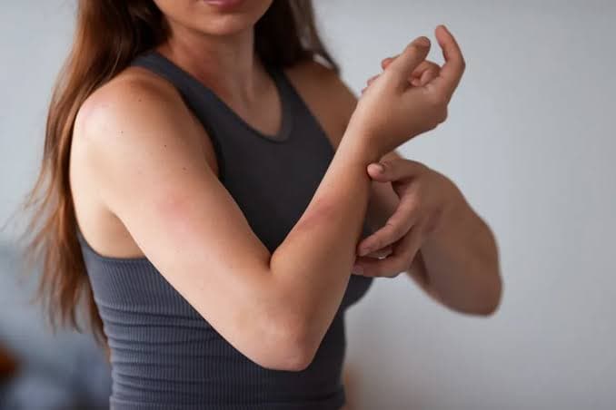 مرض لايم… الأسباب والأعراض وطرق العلاج