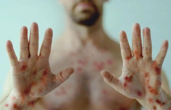 أهم 5 نصائح وإجراءات وقائية للحماية من جدري القردة