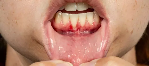 طرق العلاج و الوقاية من ذوبان عظم اللثة وانحسارها