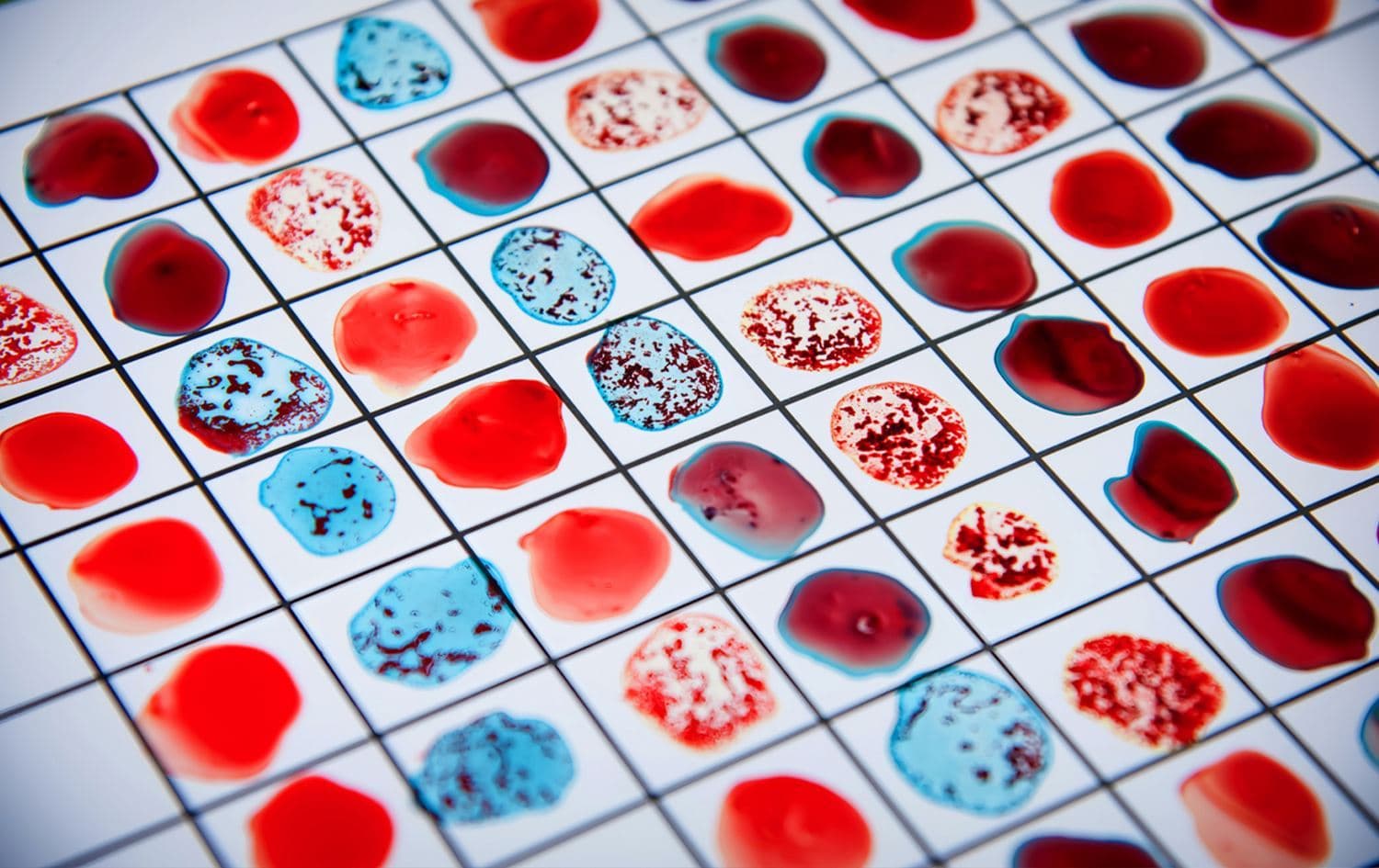 فصيلة دم قد تزيد من خطر حدوث السكتة الدماغية لدى صاحبها.. ما هي؟