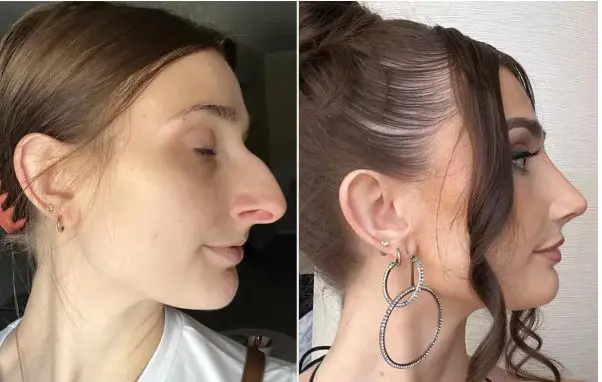 بكلفة 11 ألف دولار.. عملية تجميل للأنف حياة امرأة